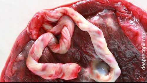 Placenta si cordon ombilical